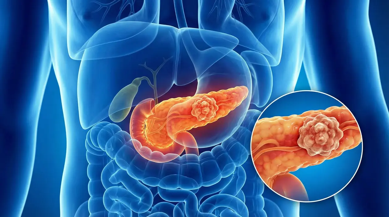 Illustrazione medica del pancreas con una massa tumorale evidenziata nell’addome umano